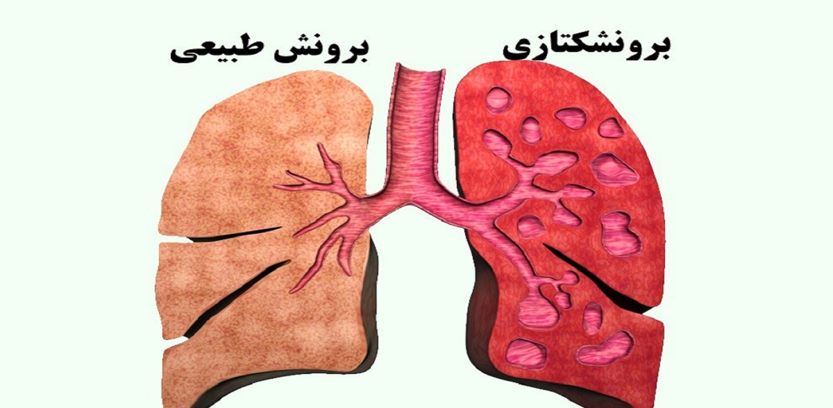 برونشکتازي